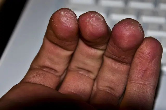 finger hurt violin - Are violin calluses bad