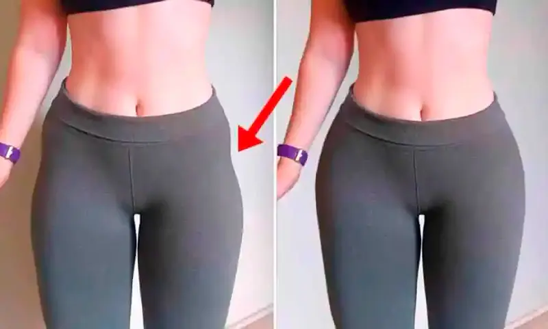 Caderas de violín: Solución y tratamiento - Cuánto cuesta un relleno de hip dips caderas de violin solucion - Cuánto cuesta un relleno de hip dips