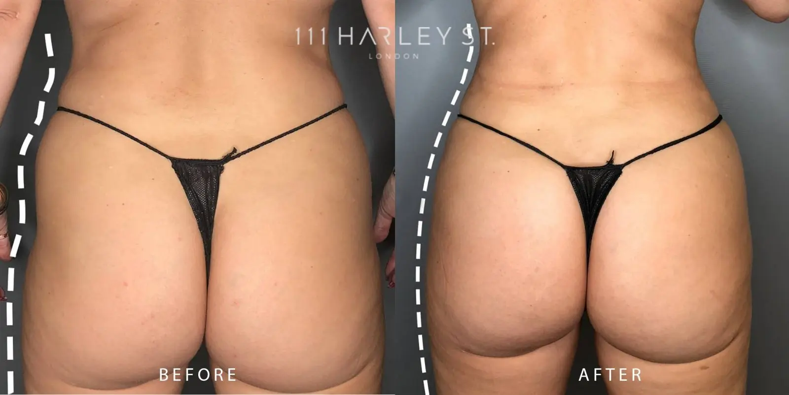 Violin Hips Before and After: Transforming Your Body with Music - How much does 20 vials of Sculptra cost violin hips before and after - How much does 20 vials of Sculptra cost