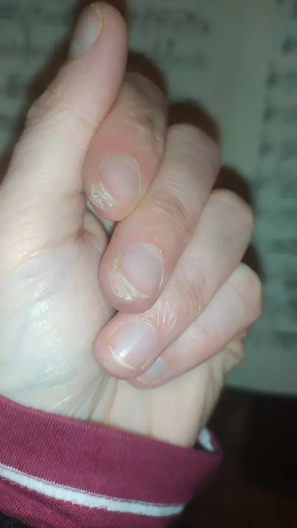 finger hurt violin - Why does my hand hurt after playing violin